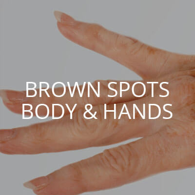 brown spots body hands